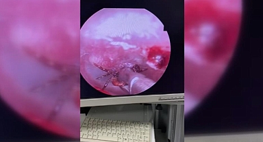 Kulak ağrısıyla hastaneye gitti, kulağından kene çıktı