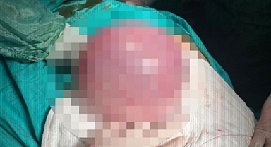 3 saatlik ameliyatla çıkarıldı!