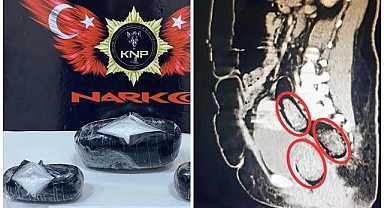 İranlı kadının içinden çıkanlar şoke etti!