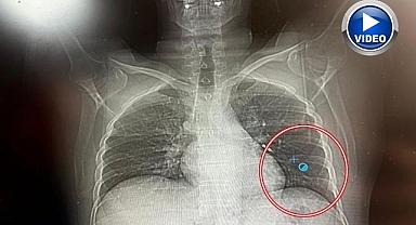 İmplant vidası ciğerine kaçan hasta ölümden döndü