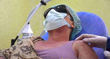 İnternetten aldığı 'leke açıcı' krem hastanelik etti