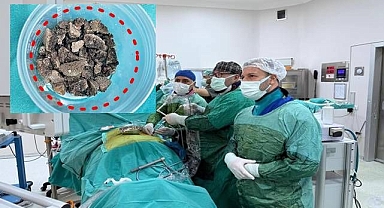 Böbreğinden geyik boynuzu çıktı