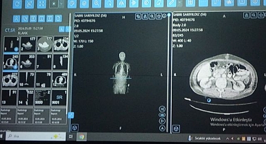 Kanser tedavisinde yapay zekâ kullanıldı