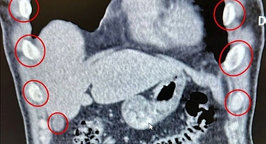 Midelerini kurye olarak kullandılar! Kapsül kapsül bakın ne taşıdılar...