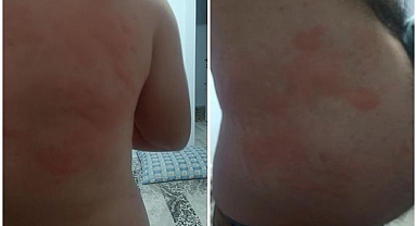 Böcek ısırığı hastanelik etti