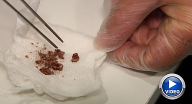 Burnundan öyle şeyler çıktı ki.. Görenler şoke oldu!