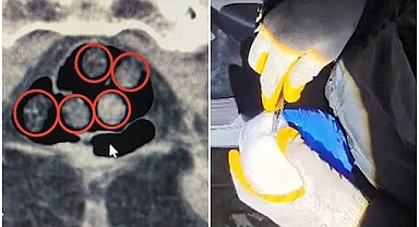 Midesinden 385 gram uyuşturucu çıktı!