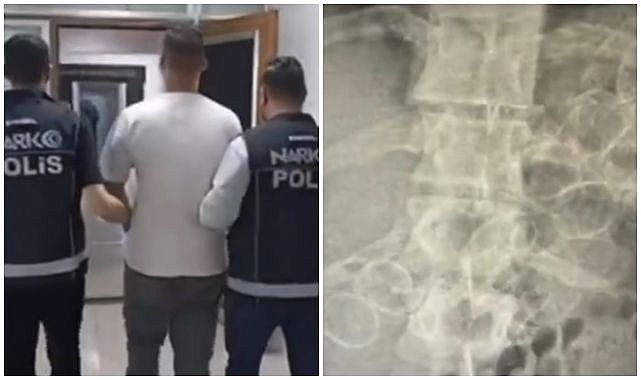 Vücudundan çıkanlar şoke etti!