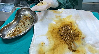 Nadir vaka: Safra kesesinden binlerce taş çıkarıldı