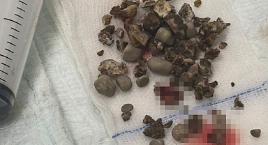 Böbrek taşı hastasına 'nokta atışı' müdahale 