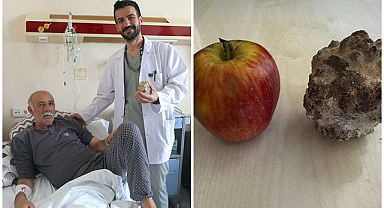 Doktorlar bile şaşkın! Hastadan elma büyüklüğünde taş çıktı 