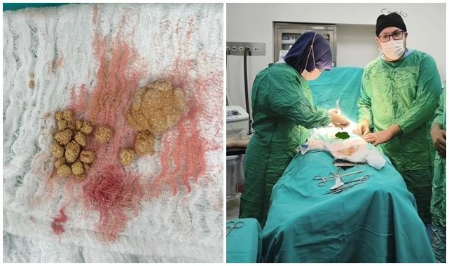 İki hastanın mesanesinden 27 taş çıkarıldı