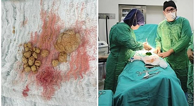 İki hastanın mesanesinden 27 taş çıkarıldı